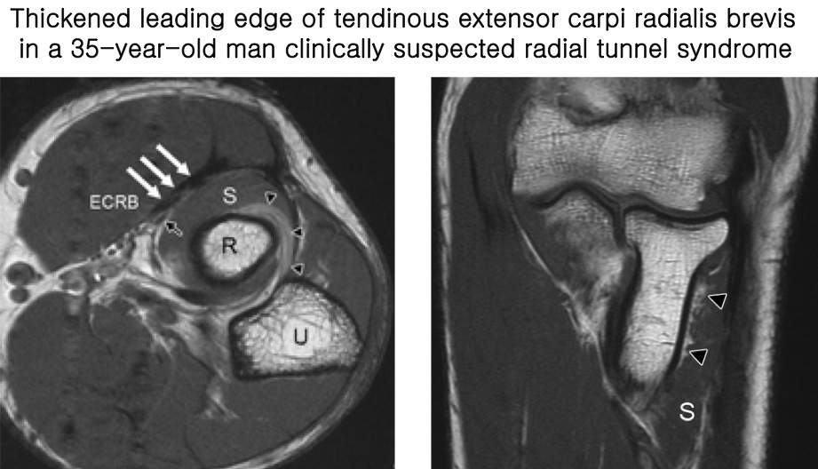 Figure 4 for case Radial tunnel syndrome
